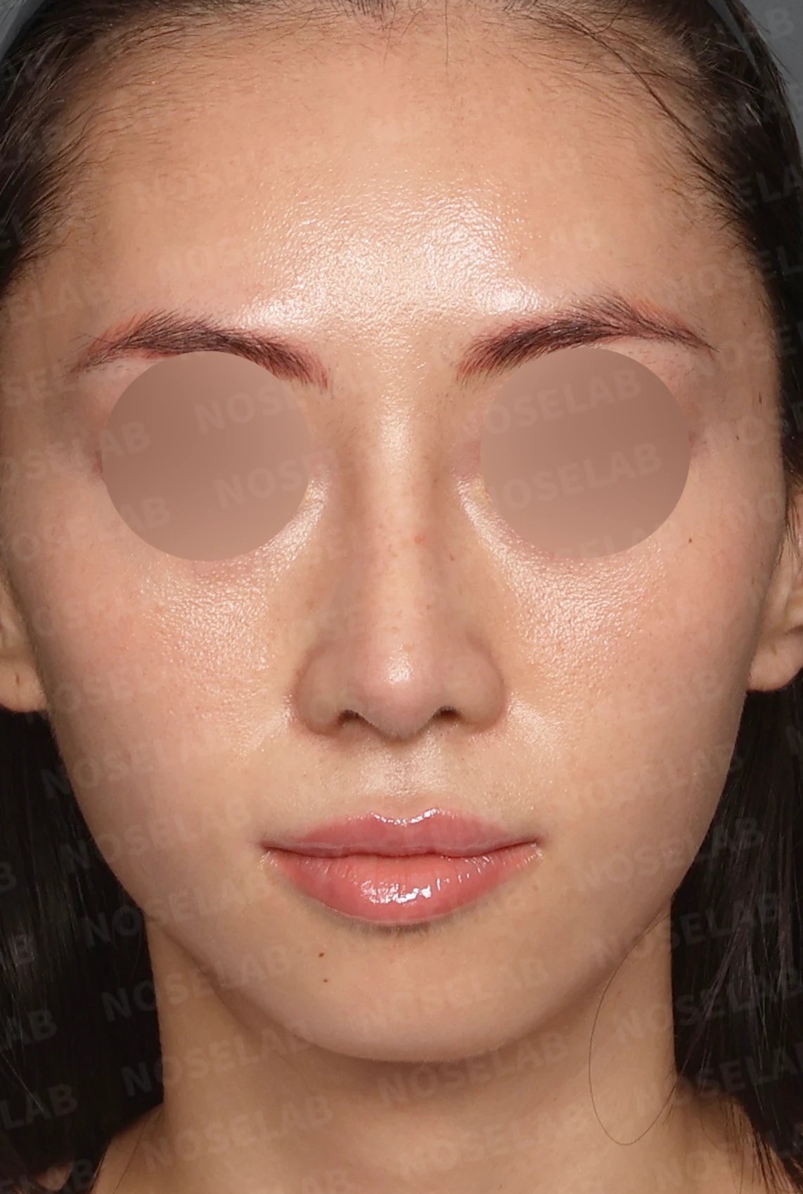자가 늑연골 코재수술, 콧대부터 코끝까지 슬림하고 여성스럽게 — 디자인 상담 정면, 좌측 측면, 비스듬한 측면 사진 입니다.