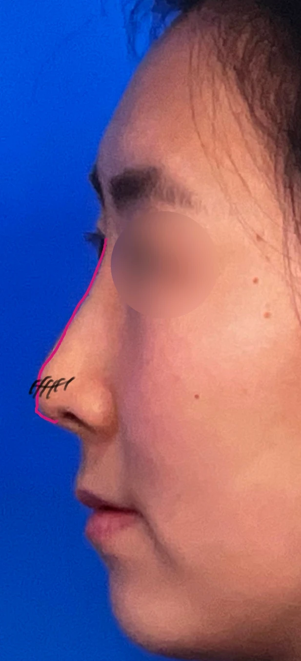 기능성 코성형·휘어진 비주 바로잡기 방법 — 본문 사진 2