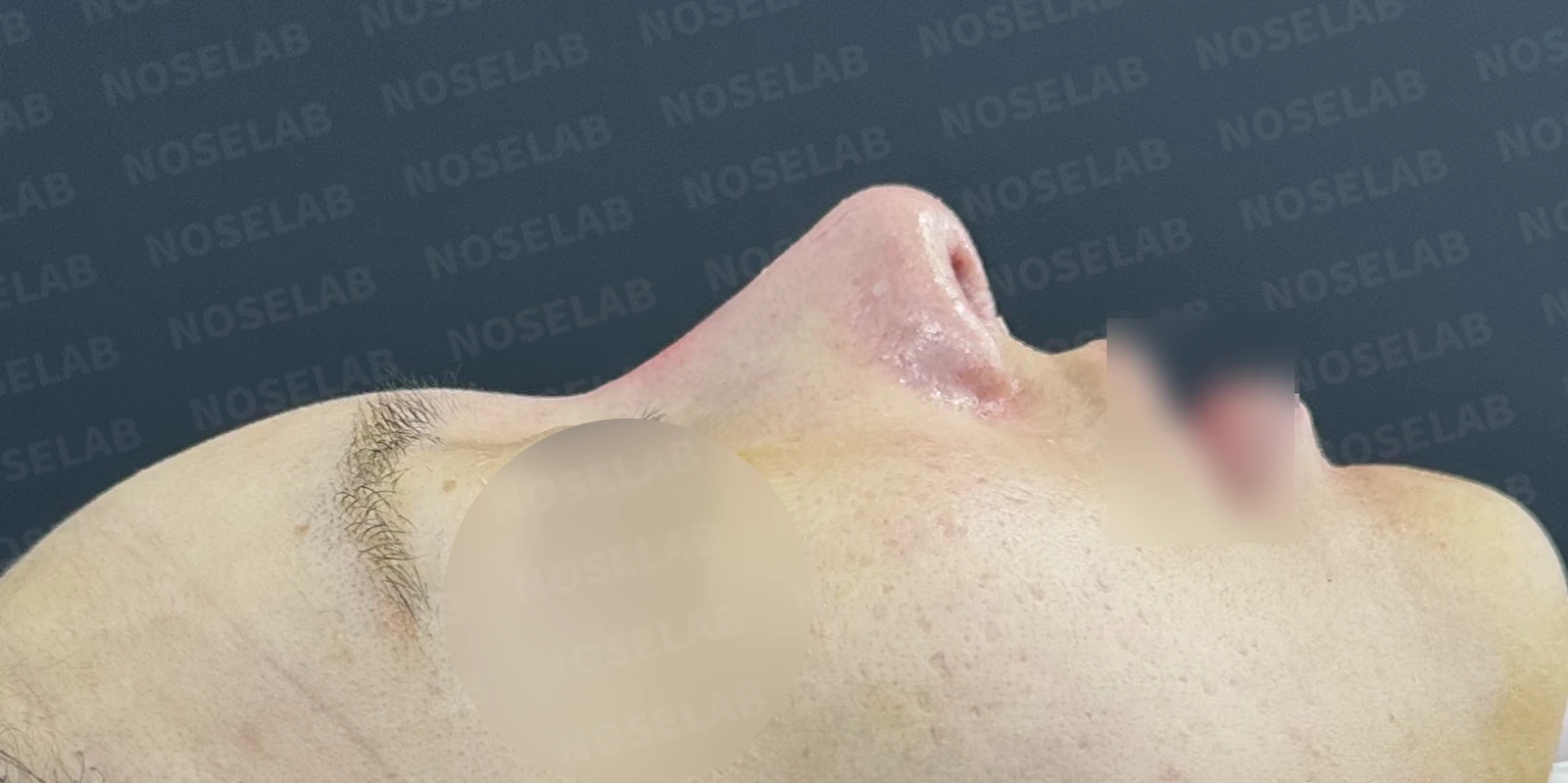 반복 수술 후 긴 코와 높은 시작점의 재수술 방법 — 수술 전 / 수술 직후 0일 직후 사진은 부기가 있는 상태로 최종 결과와 다를 수 있습니다.