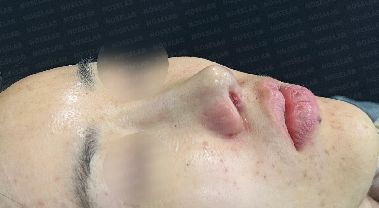 휜코, 뭉툭하고 처진코 수술 사례_대표원장 강차영 — 수술전(좌) 수술직후(우)