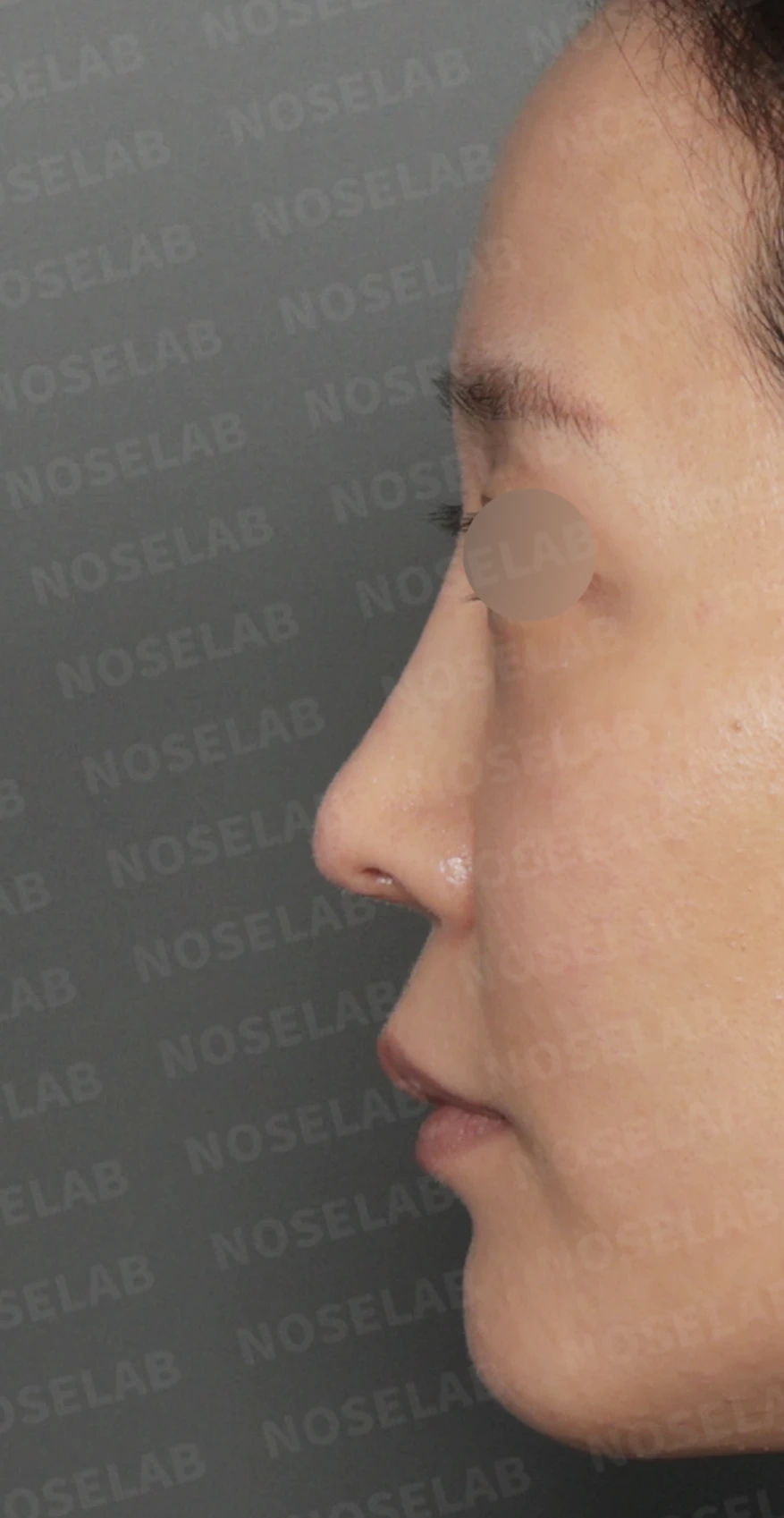 코끝 피부 함몰과 보형물 비침, 자가늑연골로 안전하게 복원한 코재수술 — 디자인 상담 — 정면, 좌측 측면, 비스듬한 측면