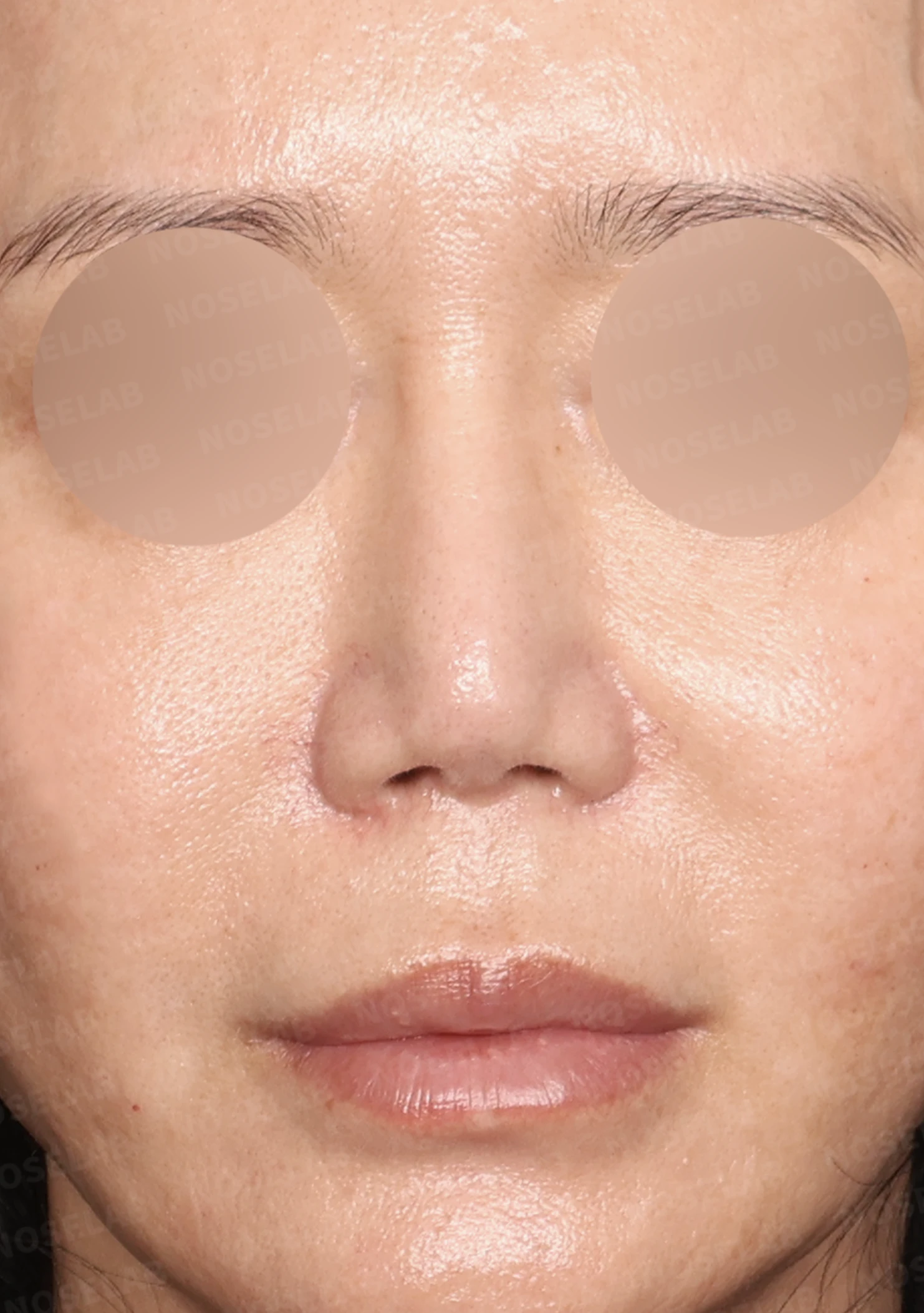 실리콘 재수술, 자가늑연골로 안전하게 코 라인 교정한 사례 — 전(좌) 직후(후)