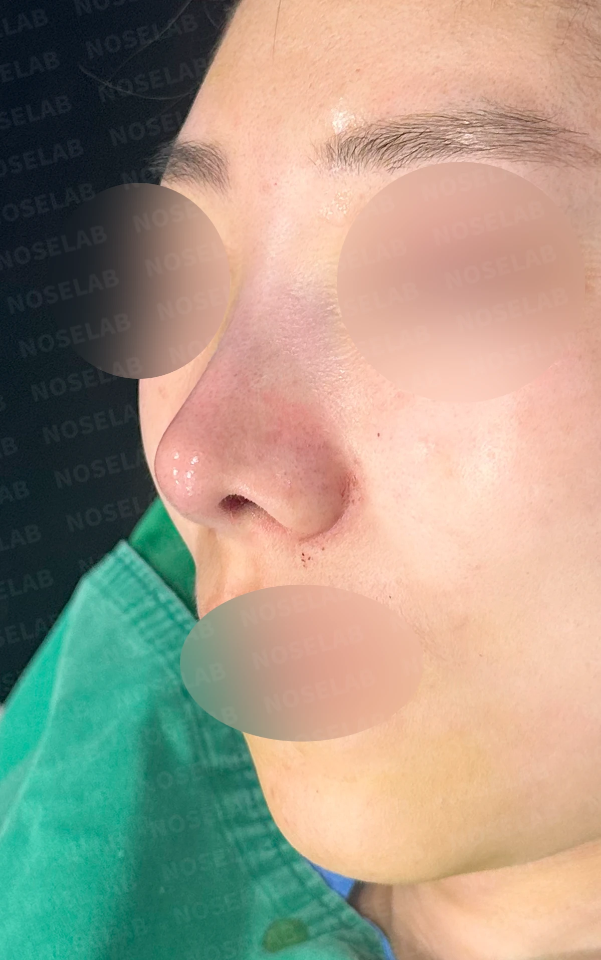 매부리를 정리한 뒤 콧등이 눌려 보이고 코끝이 뭉툭해지는 이유, 보형물 없이 교정하는 방법 — 수술 직후 0일 정면, 측면, 비스듬한 측면 사진 직후 사진은 부기가 있는 상태로 최종 결과와 다를 수 있습니다.