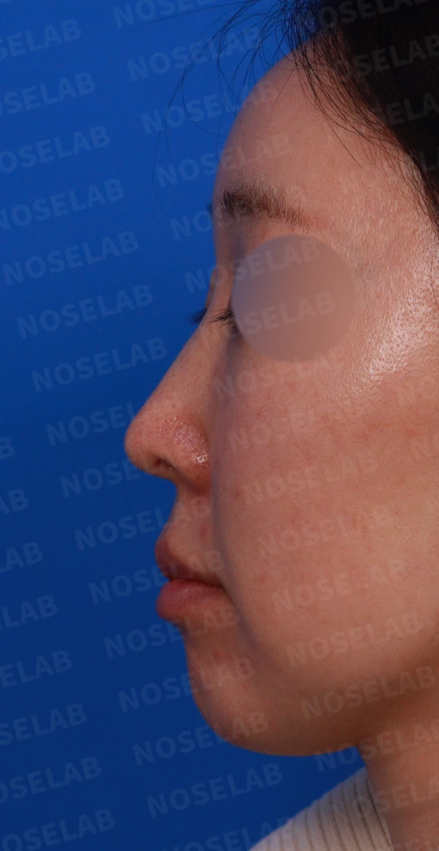 긴 코와 퍼진 콧대의 재수술 방법 — 디자인 상담 정면, 좌측 비스듬한 측면, 측면 사진