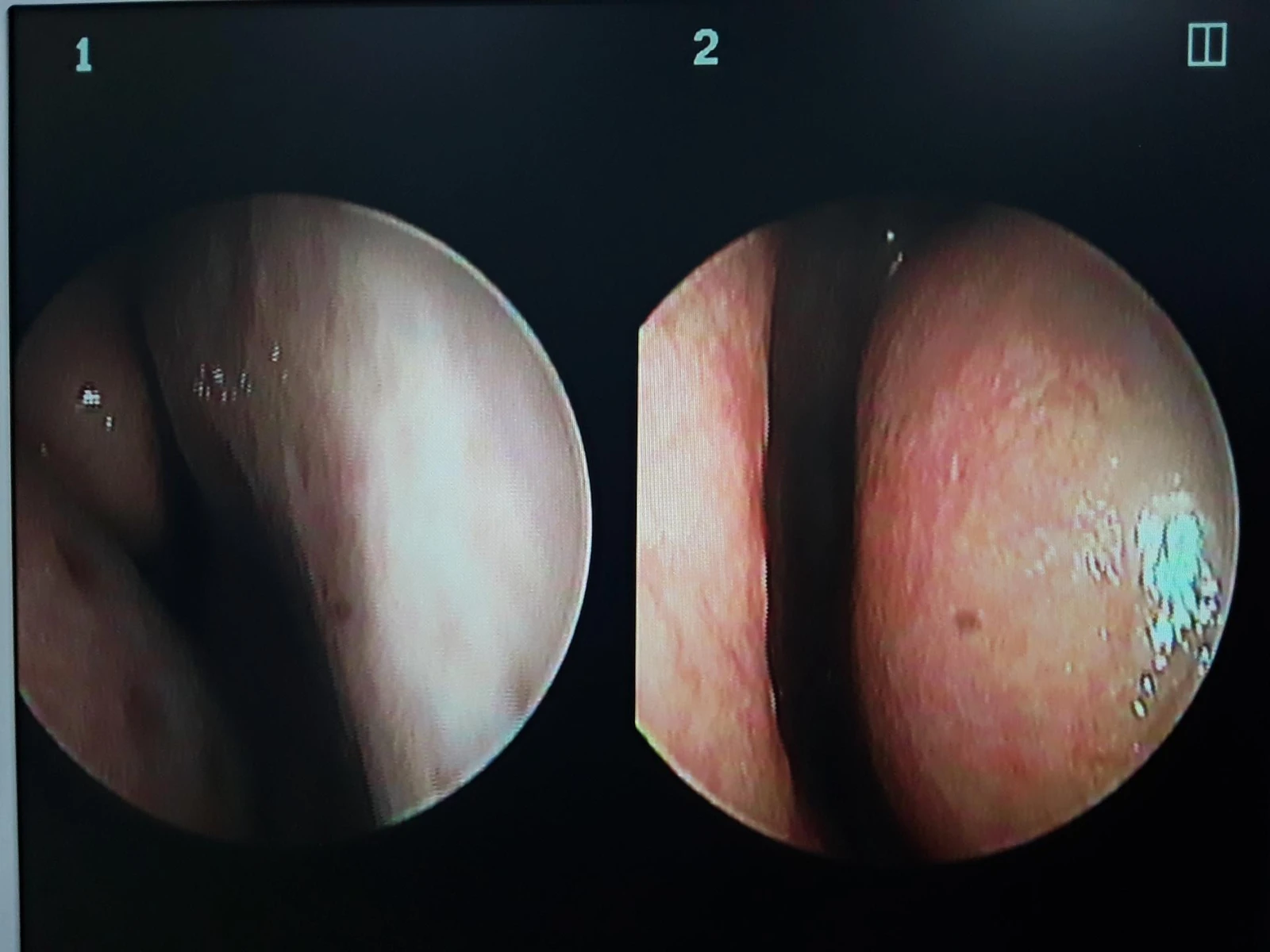 코가 짧고 들리며 비주가 함몰되는 이유, 자가 늑연골 재건은 어떻게 하나 — 코내시경 사진