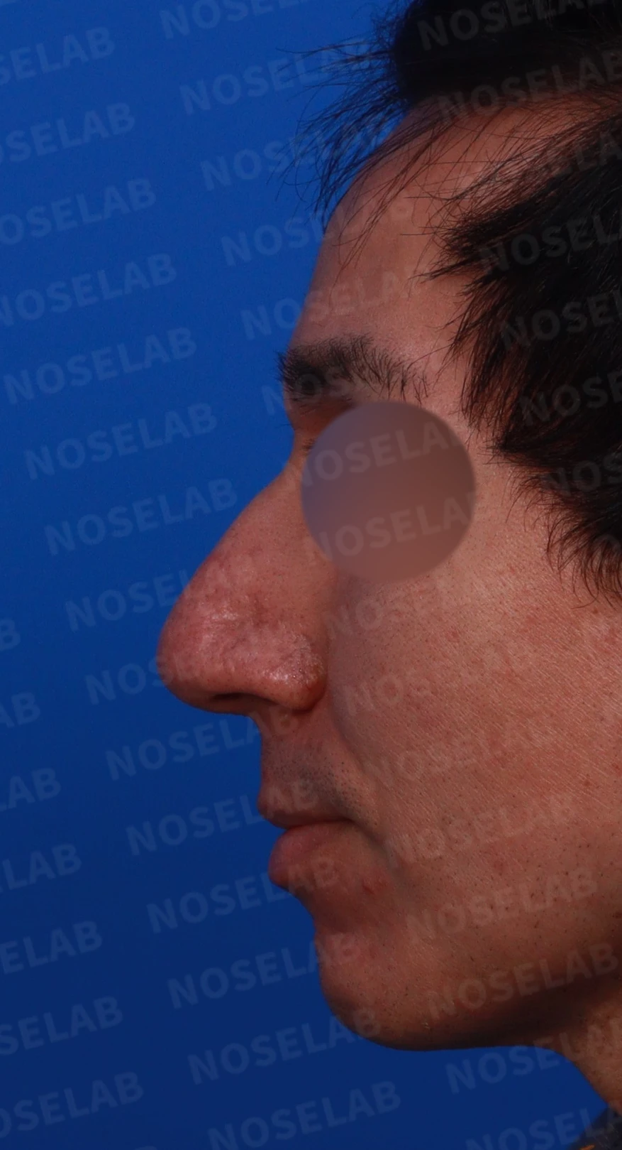 큰 코와 얼굴 비율을 함께 고려한 교정 방법 — 디자인 상담 정면, 좌측 측면, 비스듬한 측면 사진입니다.