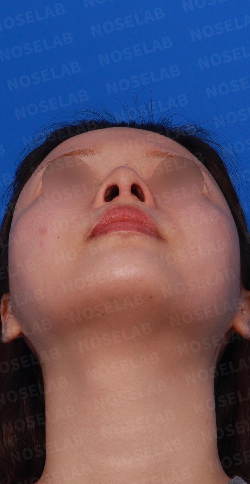 고개를 들면 콧구멍 모양이 다르고 코가 막히는 이유, 비중격 재건 방법 — 디자인 상담 우측 측면 , 비스듬한 측면 , 비공 사진입니다.
