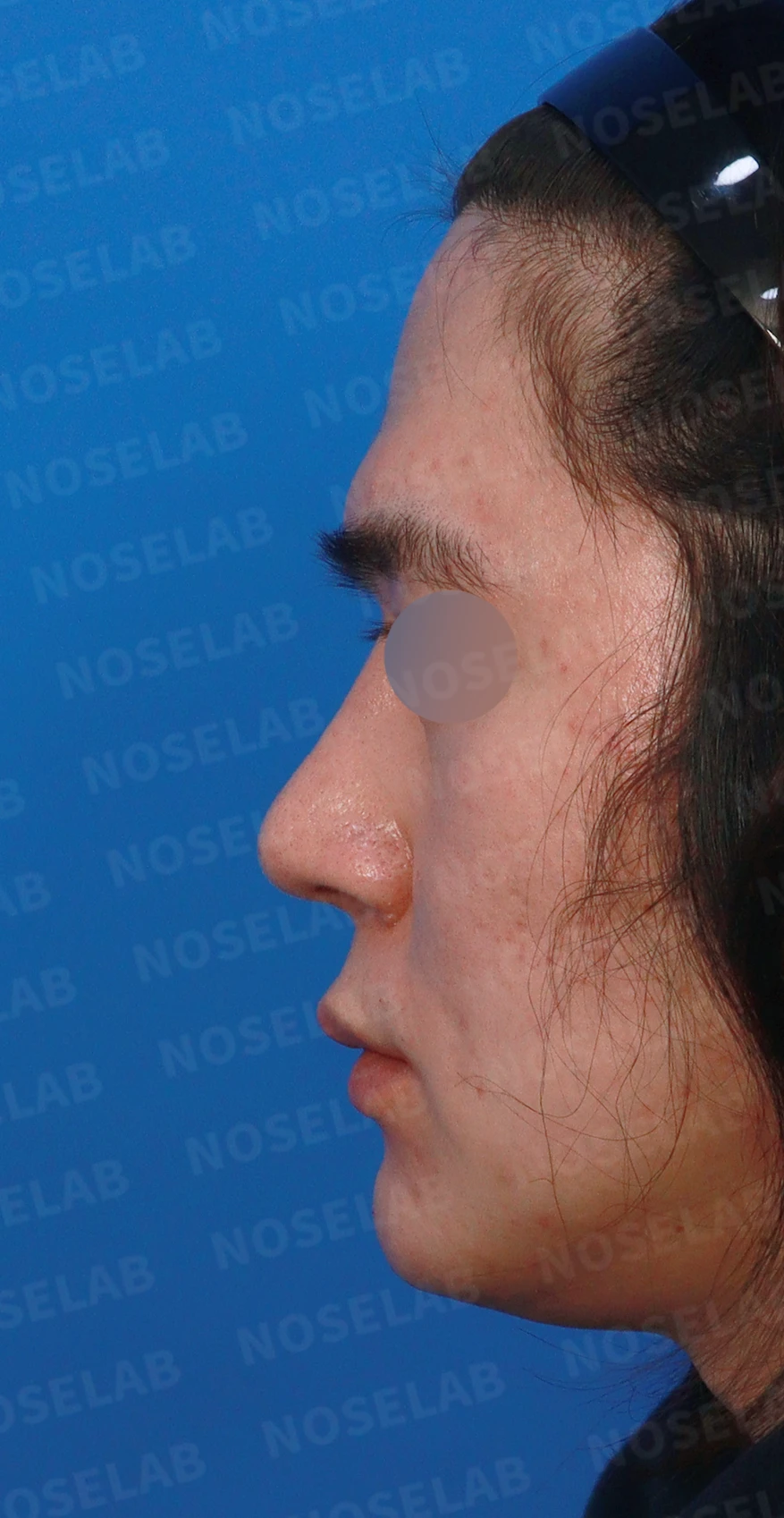 콧대를 더 높이고 싶을 때 무엇이 한계를 만드나, 3D 맞춤 보형물과 자가늑연골 코끝 지지 — 디자인 상담 정면, 좌측 측면, 비스듬한 측면 사진입니다.