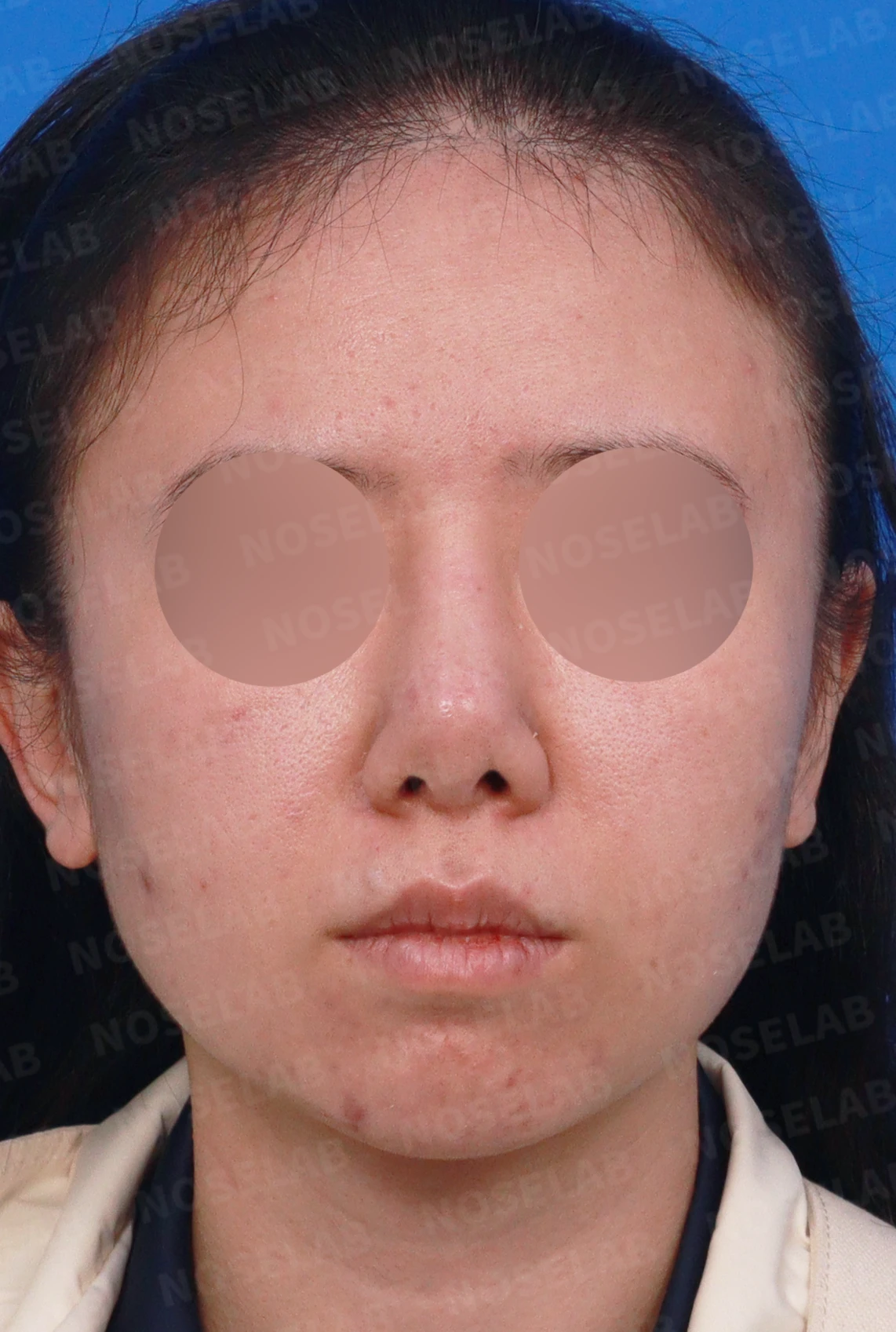 이전 수술 뒤 코가 딱딱해지고 짧아지는 구축, 왜 생기고 어떻게 재건하나 — 디자인 상담 정면, 좌측 측면, 비스듬한 측면 사진입니다.