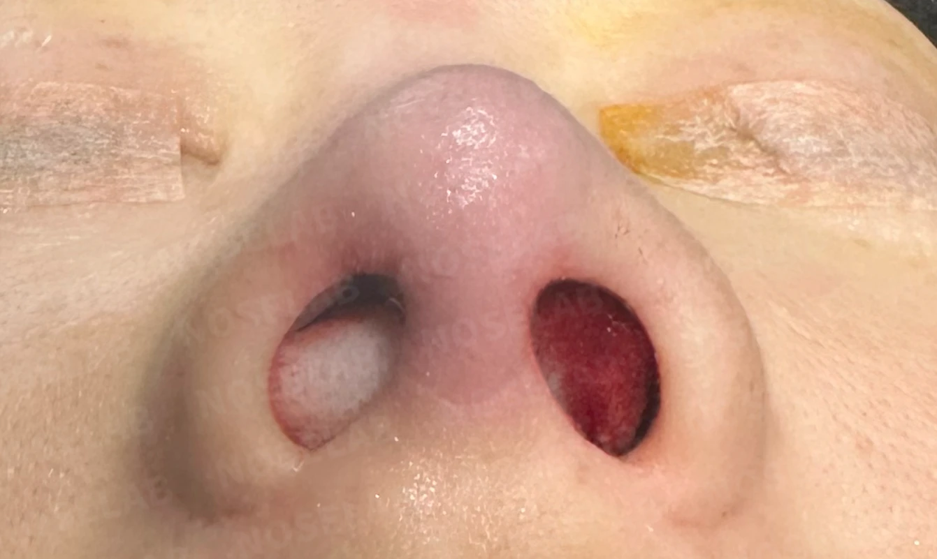 충격을 받은 뒤 코끝에서 소리가 나고 모양이 달라지는 이유와 늑연골 재건 — 수술 전 / 수술 직후 0일 직후 사진은 부기가 있는 상태로 최종 결과와 다를 수 있습니다.