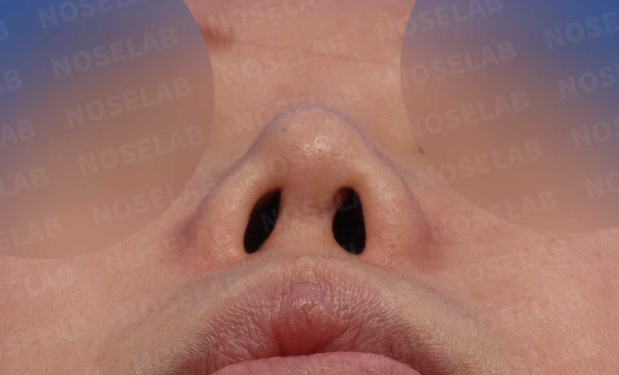 비주 함몰과 복코, 비공 비대칭의 교정 방법 — 본문 사진 4