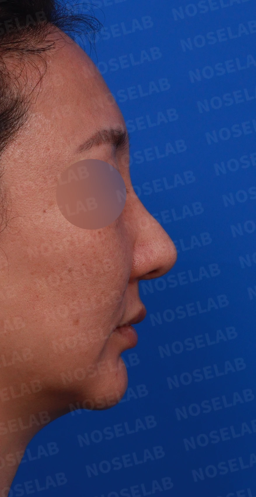 매부리 교정을 받은 코가 다시 휘어 보이는 이유와 절골 재교정 방법 — 디자인 상담 우측 비스듬한 측면, 측면, 비공 사진