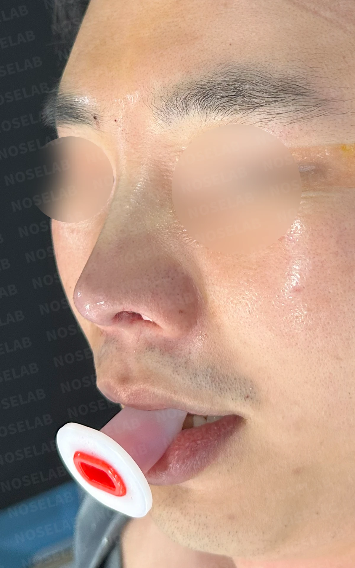 비중격 연골을 많이 쓴 코가 들리고 막히는 이유, 재건은 어떻게 하나 — 수술 직후 0일 정면 , 측면 , 비스듬한 측면 사진입니다. 직후 사진은 부기가 있는 상태로 최종 결과와 다를 수 있습니다.