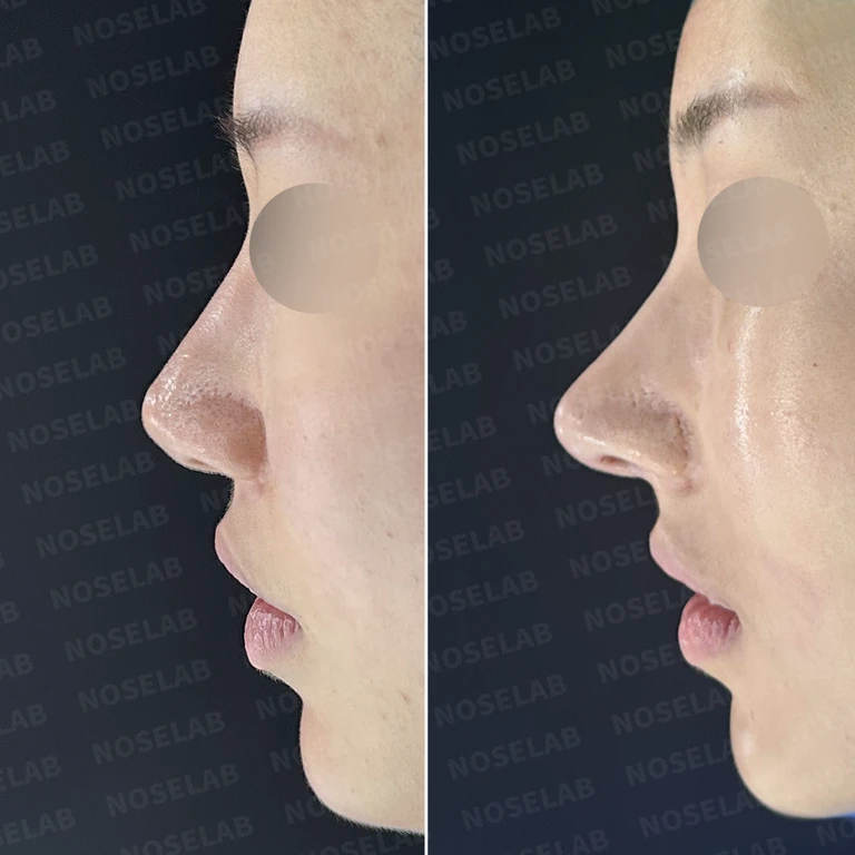 비치는 코끝 연골과 퍼진 코, 자가진피 보강으로 섬세하게 개선 — 전후 비교