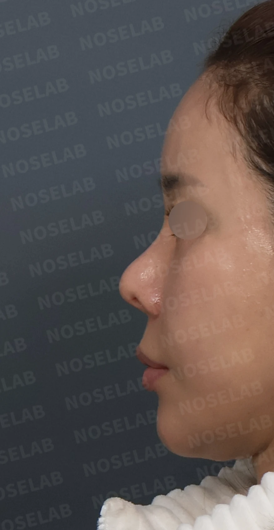 비중격 소실 후 들린 코끝과 찝혀 보이는 콧날개, 자가늑연골로 정밀 재건 — 디자인 상담 정면, 좌측 측면, 비스듬한 측면 사진입니다.