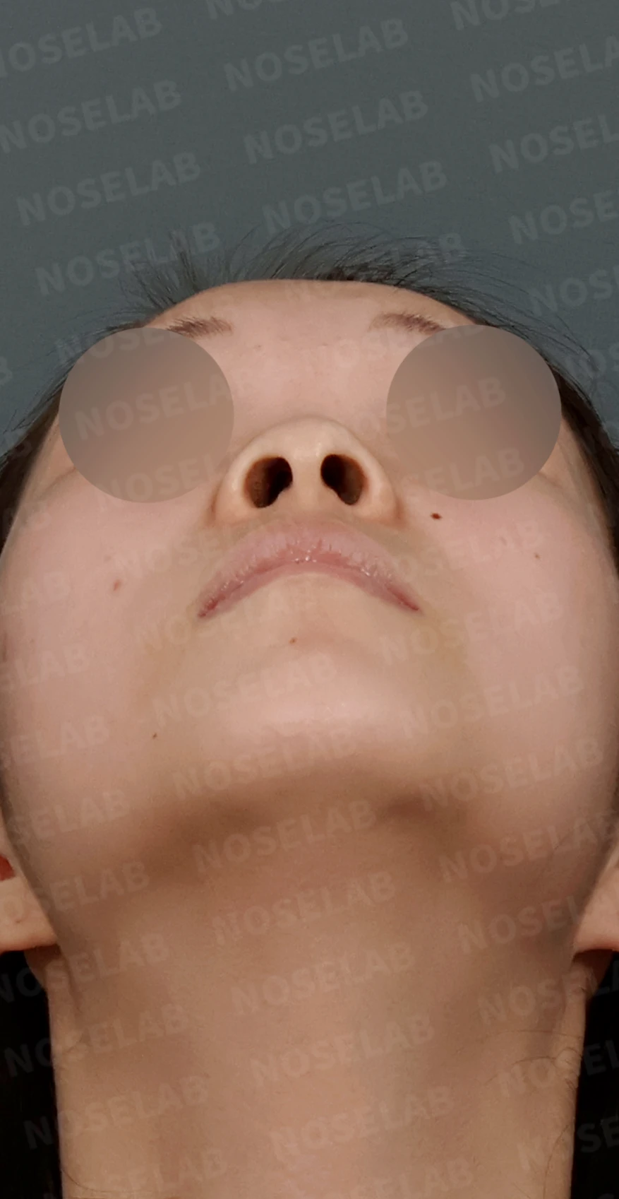 낮고 퍼진 코, 기증늑연골과 실리콘 보형물로 자연스러운 코 라인 완성 — 디자인 상담 우측 측면, 비스듬한 측면, 비공 사진입니다.