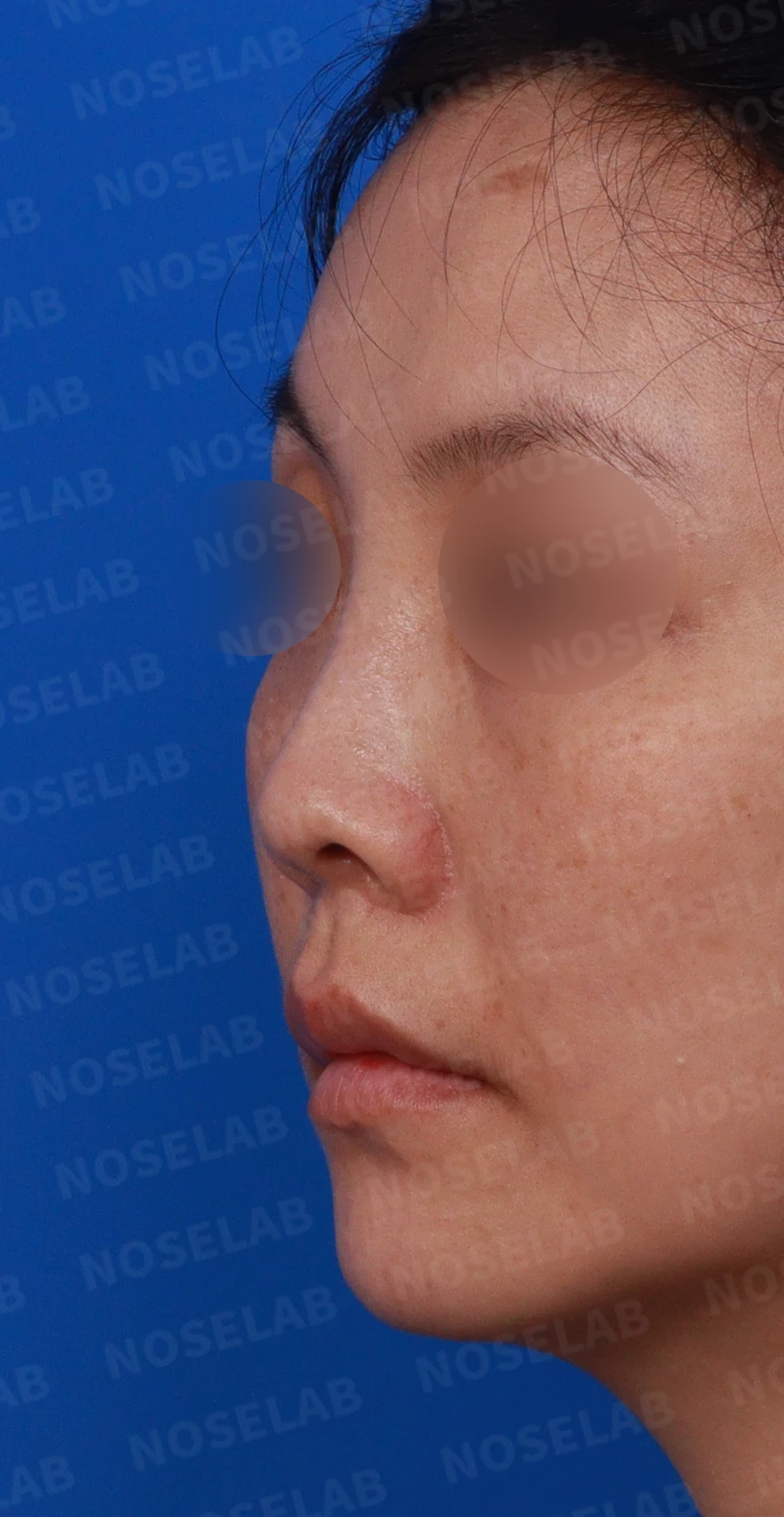 첫 코성형에서 코끝 구조와 콧구멍 노출은 어떻게 다루나 — 디자인 상담 정면 , 좌측 비스듬한 측면 , 측면 사진입니다.