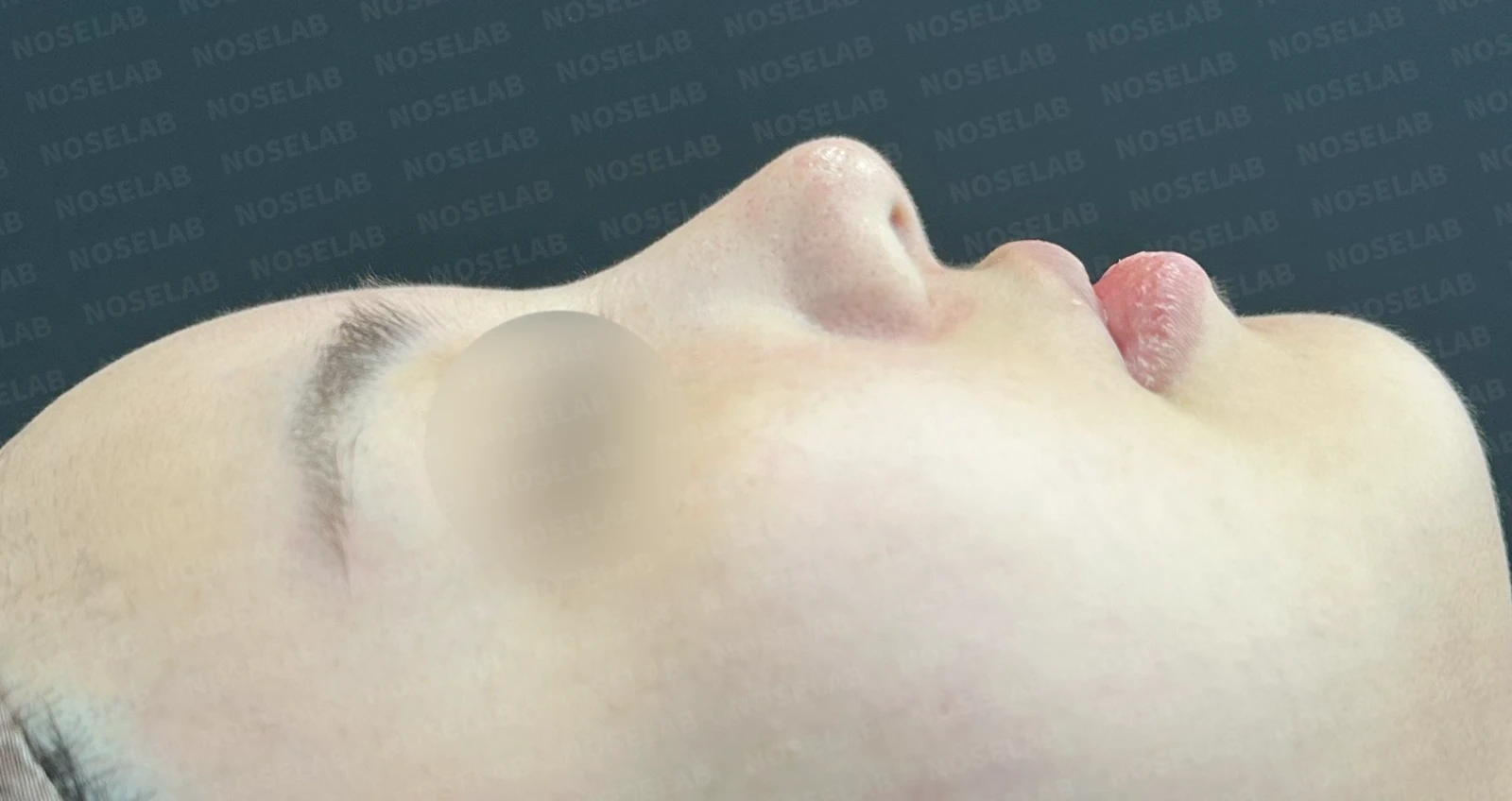 퍼진 코 개선과 콧구멍 비대칭 교정 방법 — 본문 사진 13