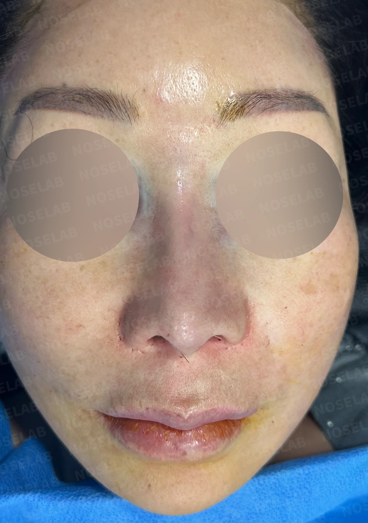 코 안에 남은 메드포어와 이물질, 왜 문제가 되고 어떻게 제거하나 — 수술 직후 0일 정면, 측면, 비스듬한 측면 사진 직후 사진은 부기가 있는 상태로 최종 결과와 다를 수 있습니다.