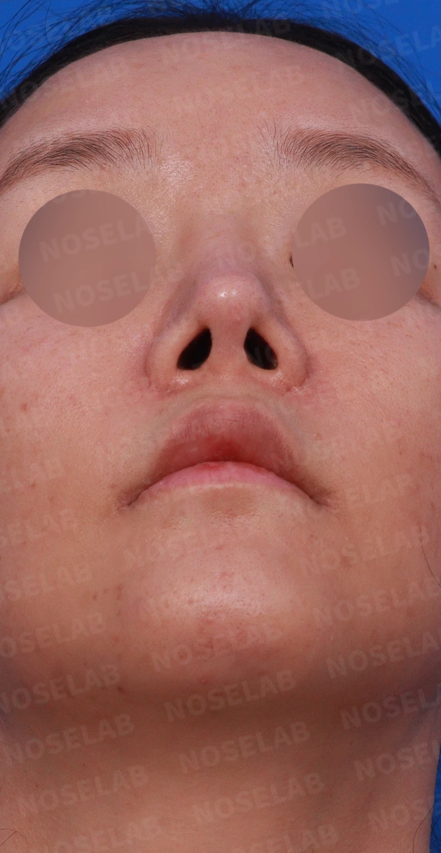 흡수된 기증늑연골을 자가늑연골로 교체 사례 — 디자인 상담 비공, 우측 측면, 비스듬한 측면 사진
