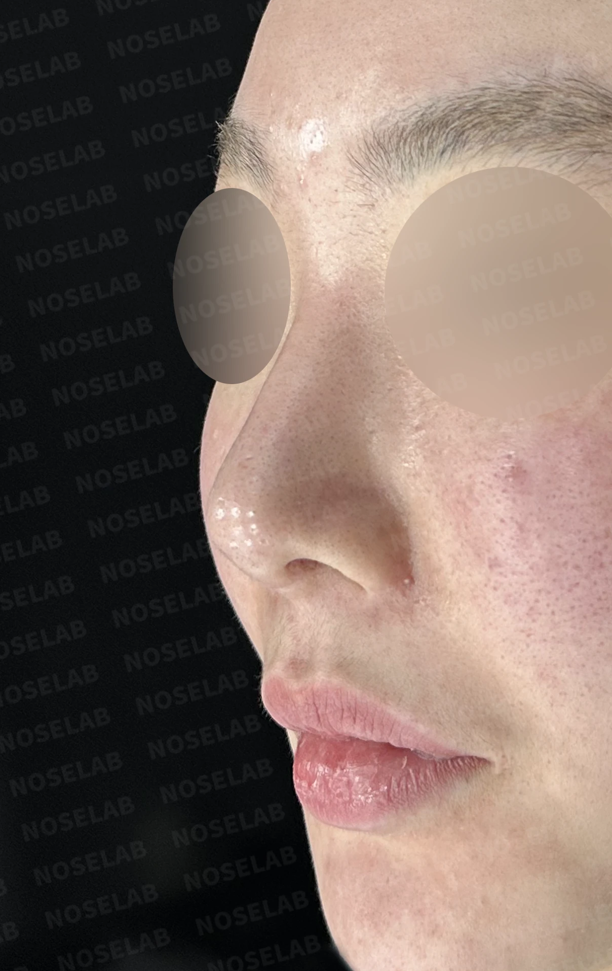 이물질 제거와 자가늑연골 비중격 재건, 들린 코 교정한 코재수술 — 전(좌) 직후(후)