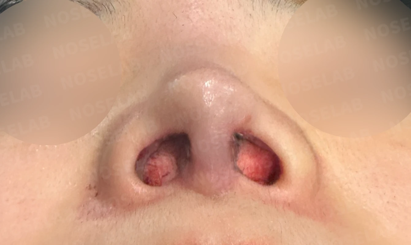 퍼진 콧대와 들린 코끝은 왜 생기나, 늑연골 재건은 어떻게 하나 — 수술 직후 0일 비공 사진 직후 사진은 부기가 있는 상태로 최종 결과와 다를 수 있습니다.