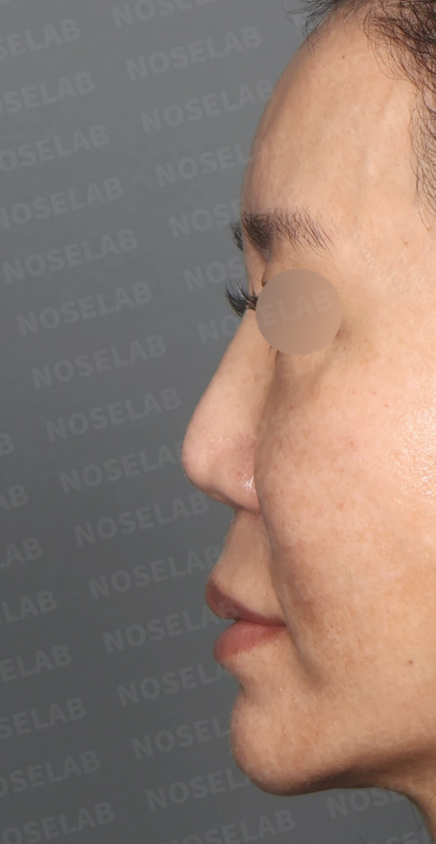 실리콘 재수술, 자가늑연골로 안전하게 코 라인 교정한 사례 — 디자인 상담 정면, 좌측 측면, 비스듬한 측면 사진입니다.