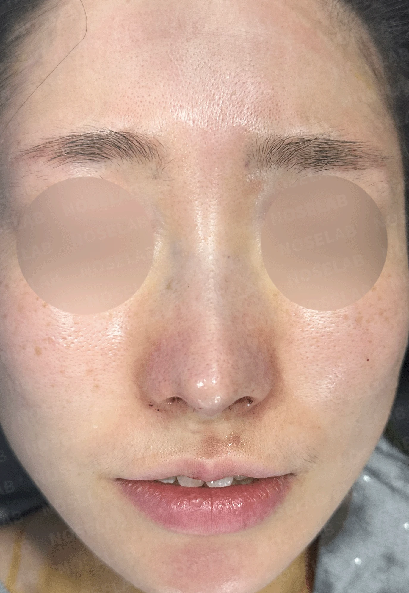 매부리코와 휜 코에 코막힘이 함께 오는 이유, 복합 교정은 어떻게 하나 — 수술 직후 0일 정면, 측면, 비스듬한 측면 사진입니다. 직후 사진은 부기가 있는 상태로 최종 결과와 다를 수 있습니다.