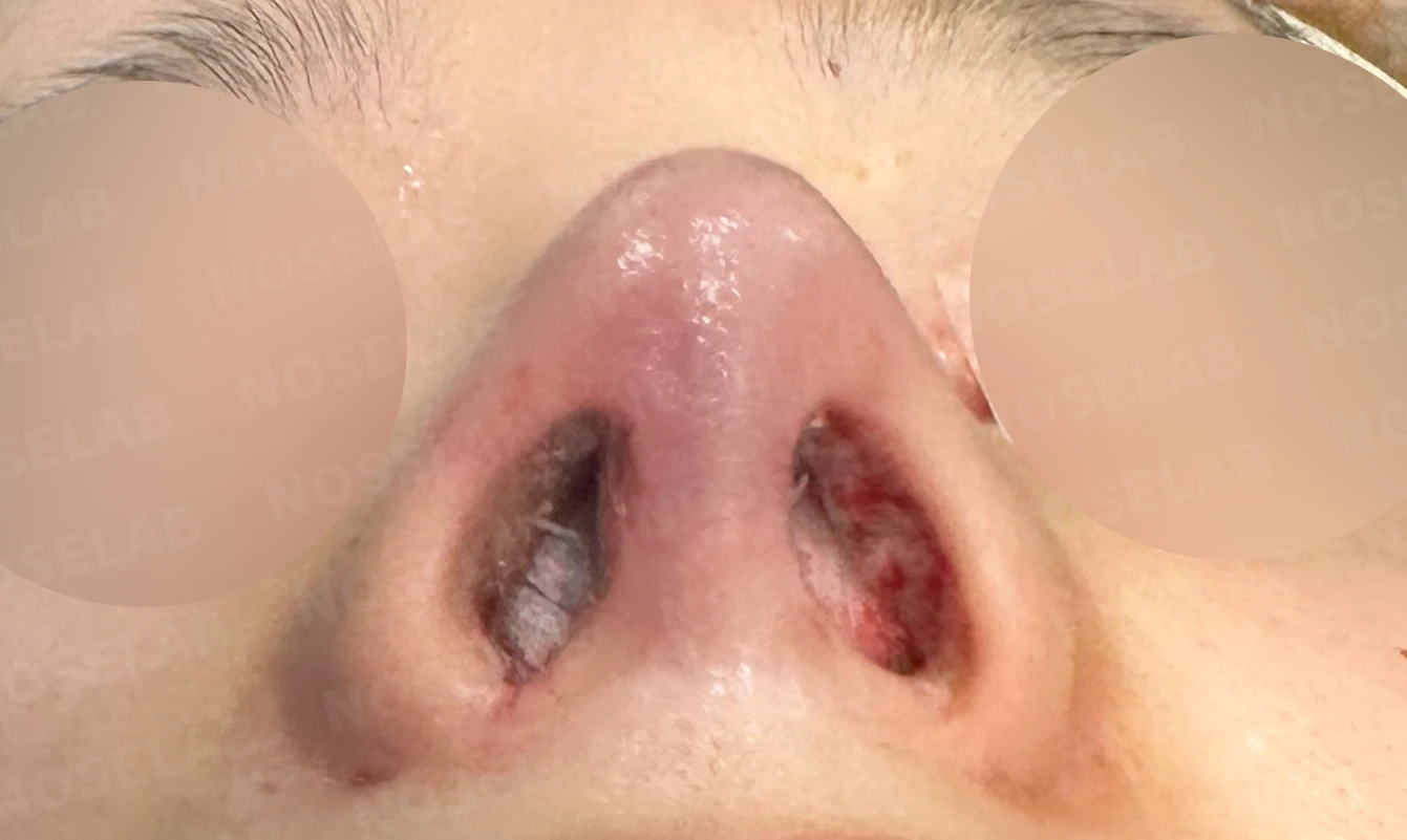 귀연골만으로 코끝을 받쳤을 때 생기는 변화와 늑연골 재건 방법 — 수술 직후 0일 비공 사진 직후 사진은 부기가 있는 상태로 최종 결과와 다를 수 있습니다.