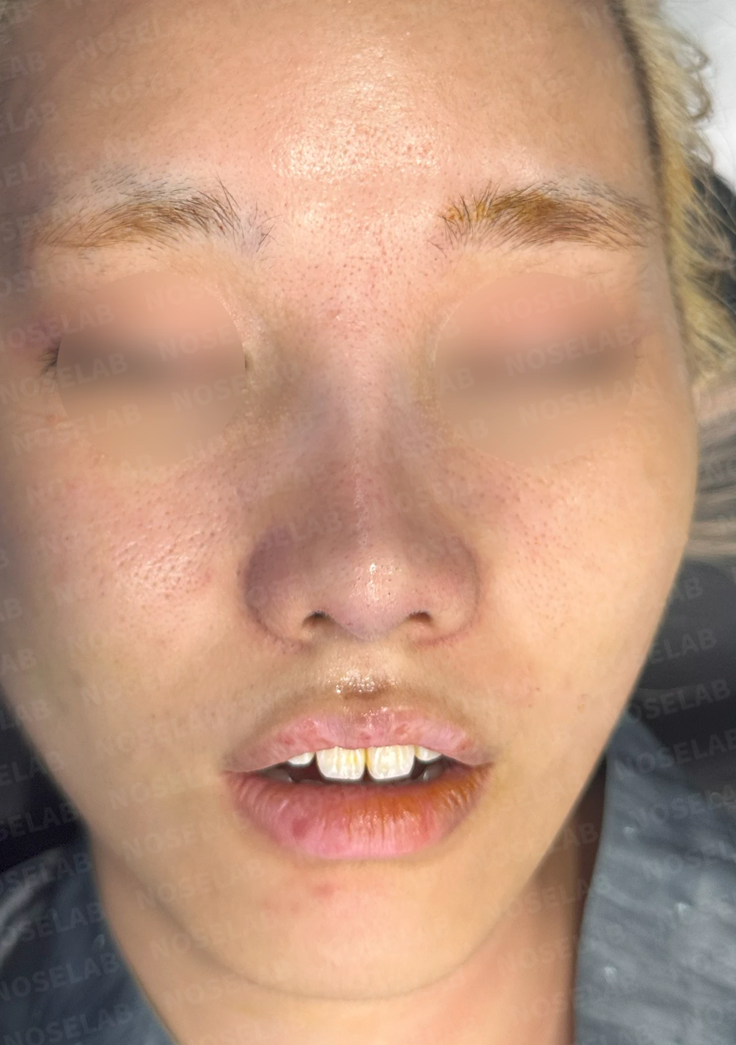 작고 뭉툭한 코는 어디까지 높일 수 있나 — 피부의 한계와 재건 방법 — 수술 전 / 수술 직후 0일 직후 사진은 부기가 있는 상태로 최종 결과와 다를 수 있습니다.