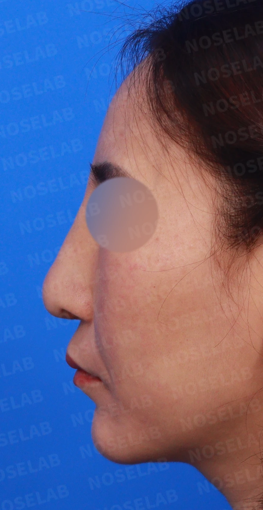 무자격 불법 주사 뒤 콧구멍이 좁아지는 이유와 제거·재건 방법 — 디자인 상담 정면, 좌측 측면, 비스듬한 측면 사진입니다.
