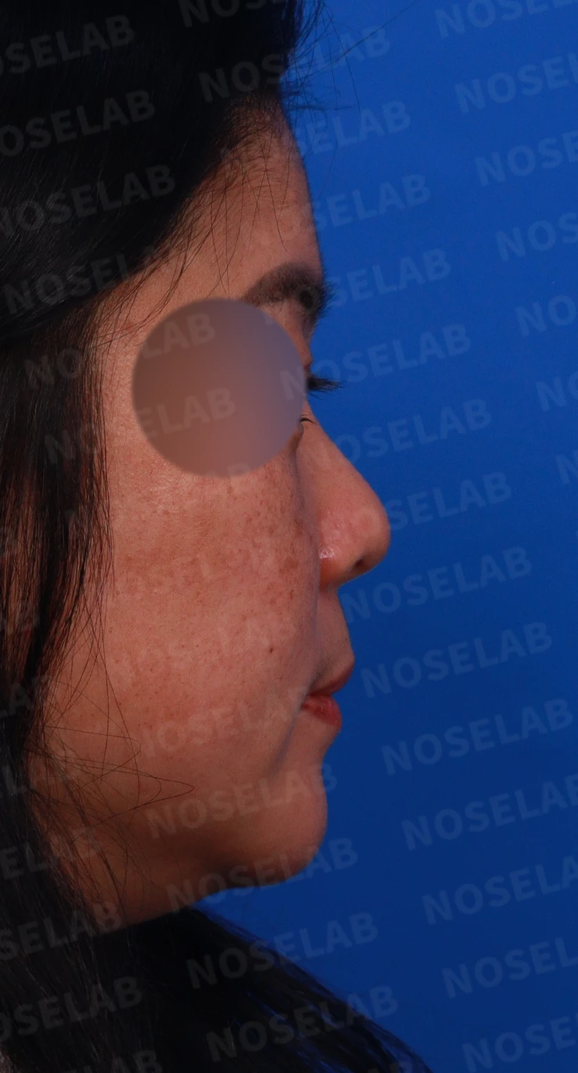 짧은 코와 코막힘을 함께 교정하는 방법 — 디자인 상담 우측 측면, 비스듬한 측면, 비공 사진입니다.