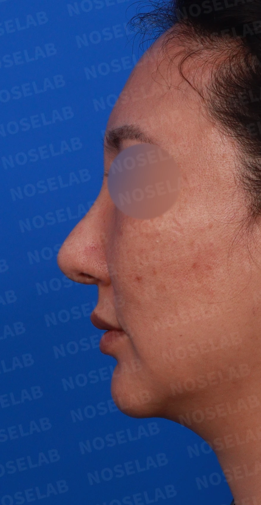 매부리 교정을 받은 코가 다시 휘어 보이는 이유와 절골 재교정 방법 — 디자인 상담 정면, 좌측 측면, 비스듬한 측면 사진