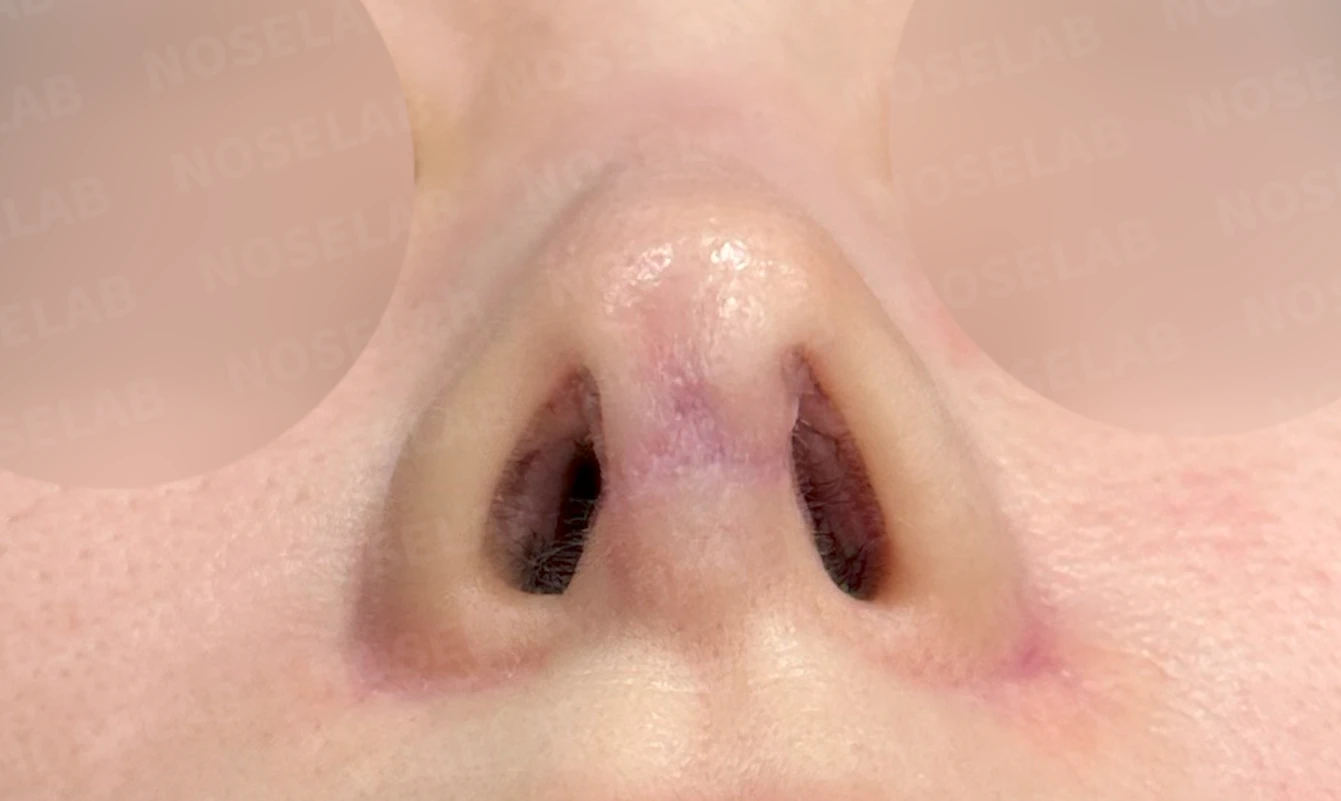 코성형 후 남는 미세한 높이 부족과 좌우 비대칭, 왜 생기고 어떻게 보강하나 — 수술 전 / 수술 직후 0일 직후 사진은 부기가 있는 상태로 최종 결과와 다를 수 있습니다.