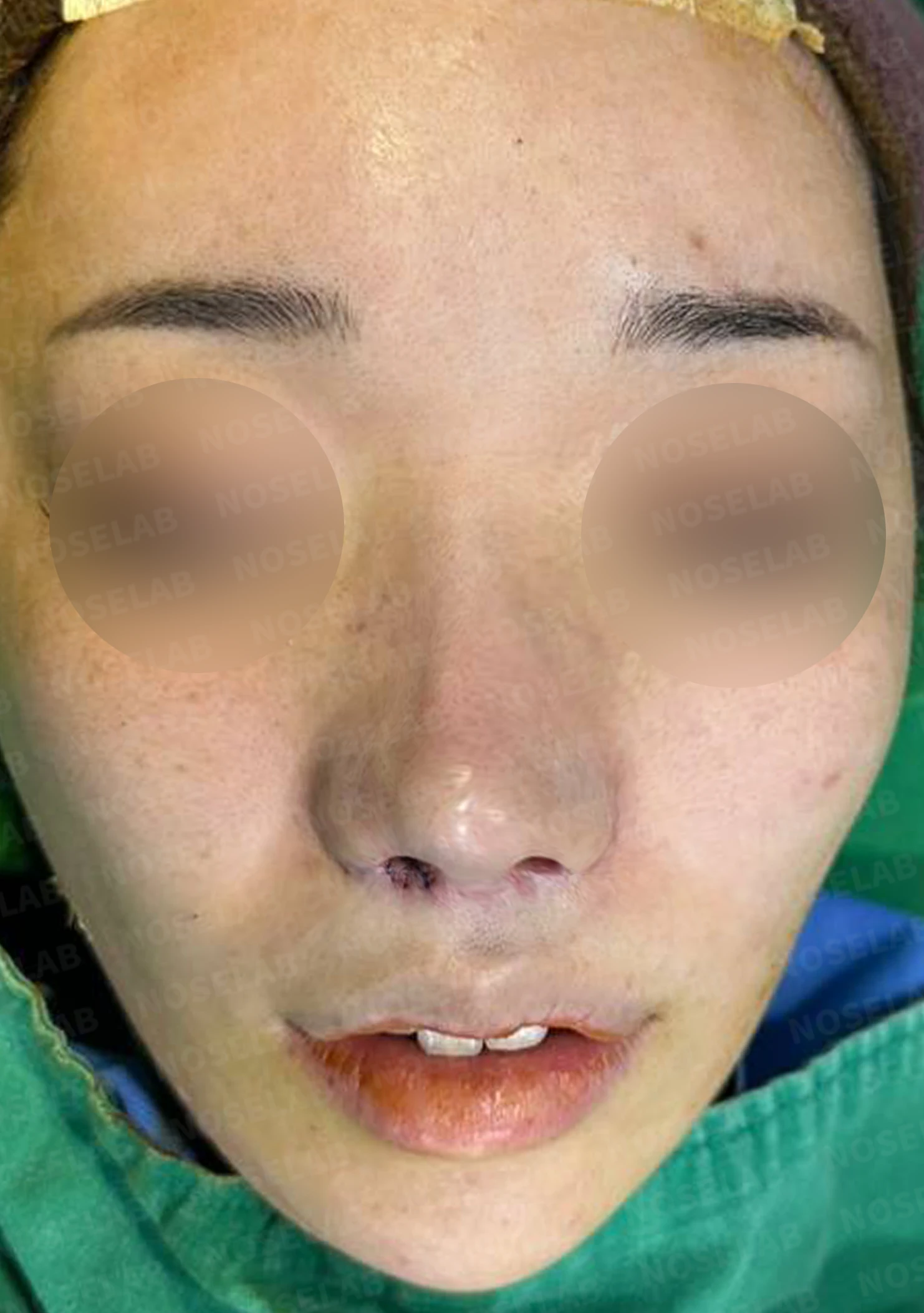 콧구멍 비대칭과 협착이 생기는 이유, 늑연골 재건과 Z성형은 어떻게 하나 — 수술 전 / 수술 직후 0일 직후 사진은 부기가 있는 상태로 최종 결과와 다를 수 있습니다.