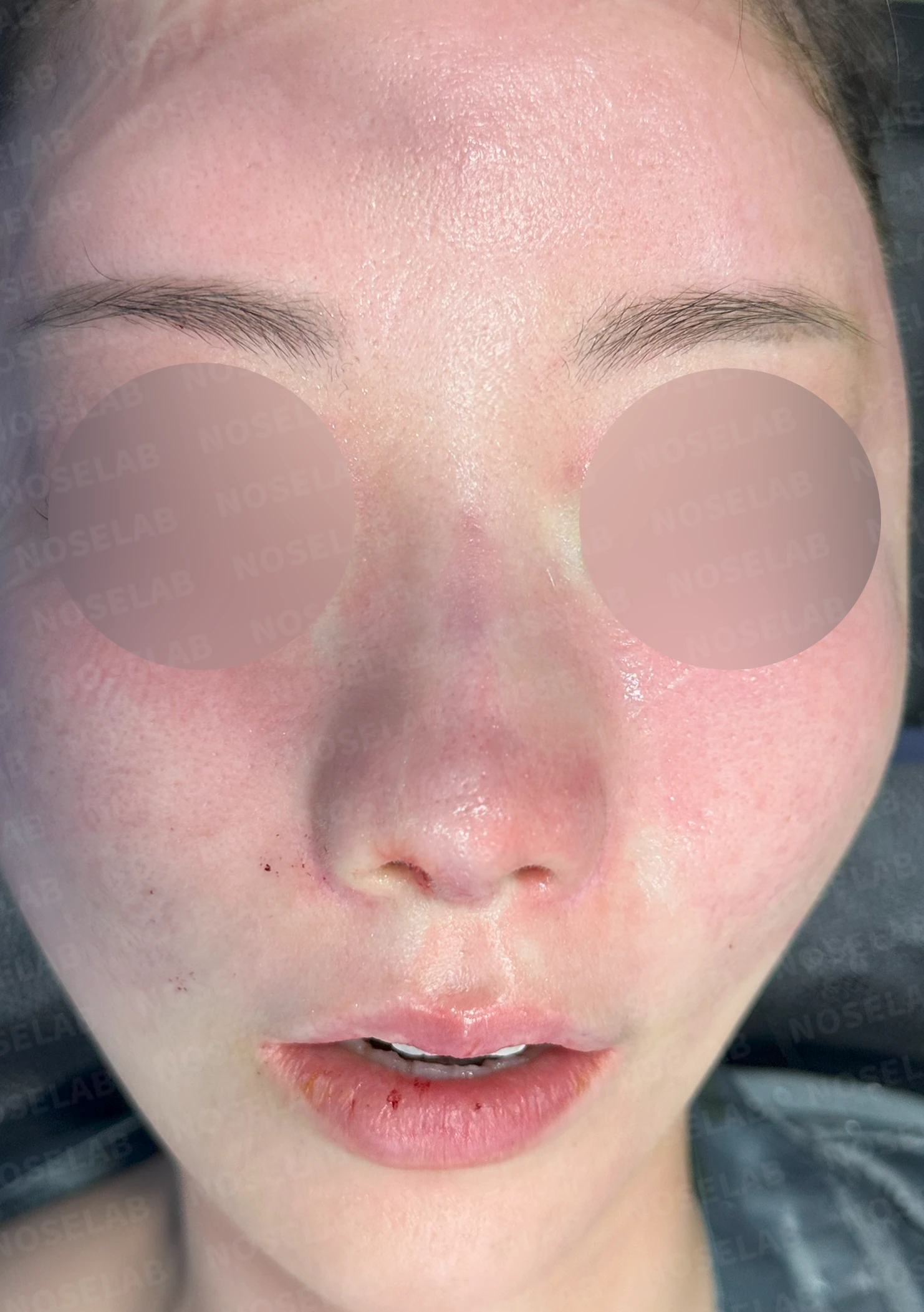 코성형 후 남는 미세한 높이 부족과 좌우 비대칭, 왜 생기고 어떻게 보강하나 — 수술 전 / 수술 직후 0일 직후 사진은 부기가 있는 상태로 최종 결과와 다를 수 있습니다.