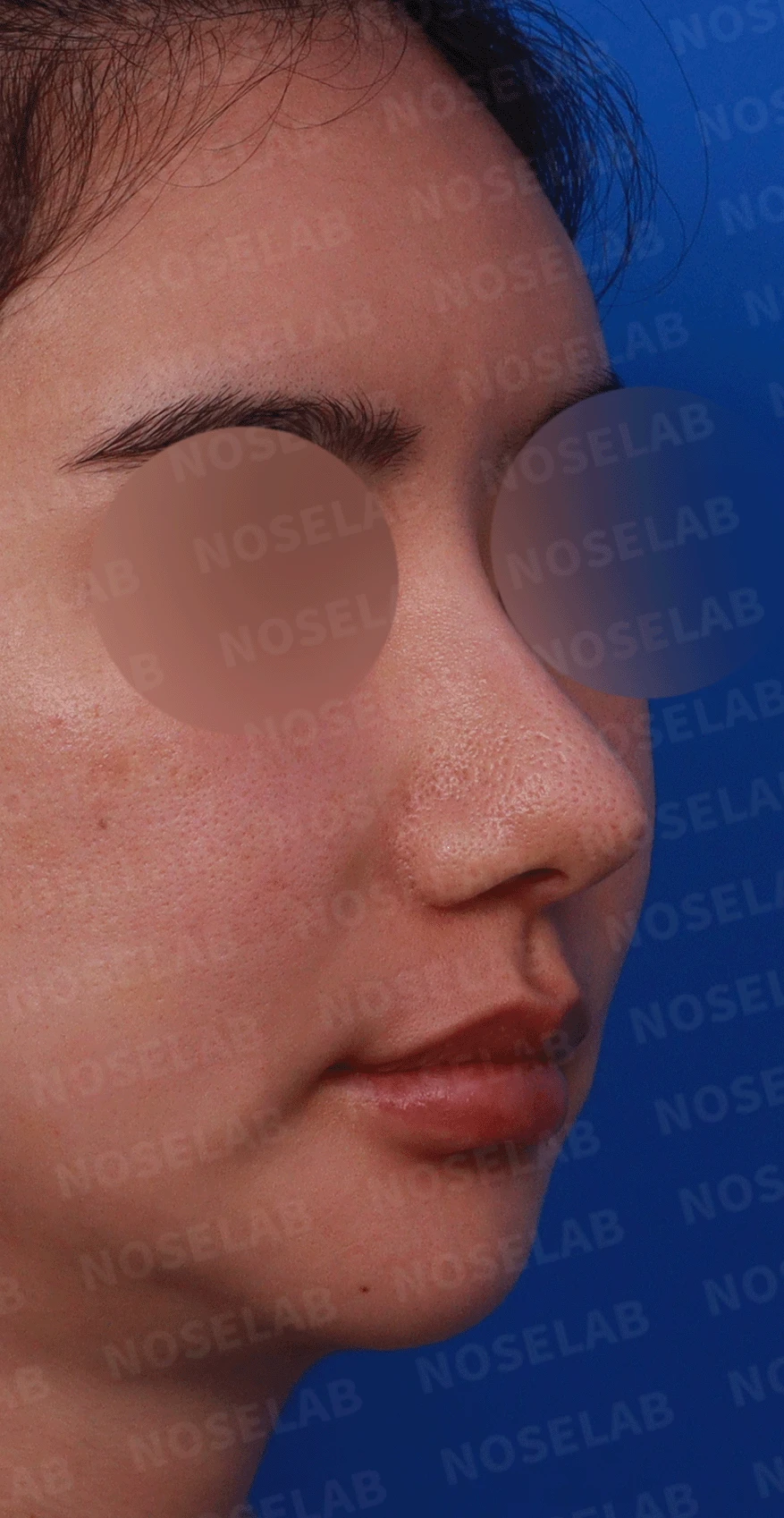 코가 과하게 높아져 부자연스러워 보이고 휘는 이유, 재건은 어떻게 하나 — 디자인 상담 우측 비스듬한 측면 , 측면 , 비공 사진입니다.