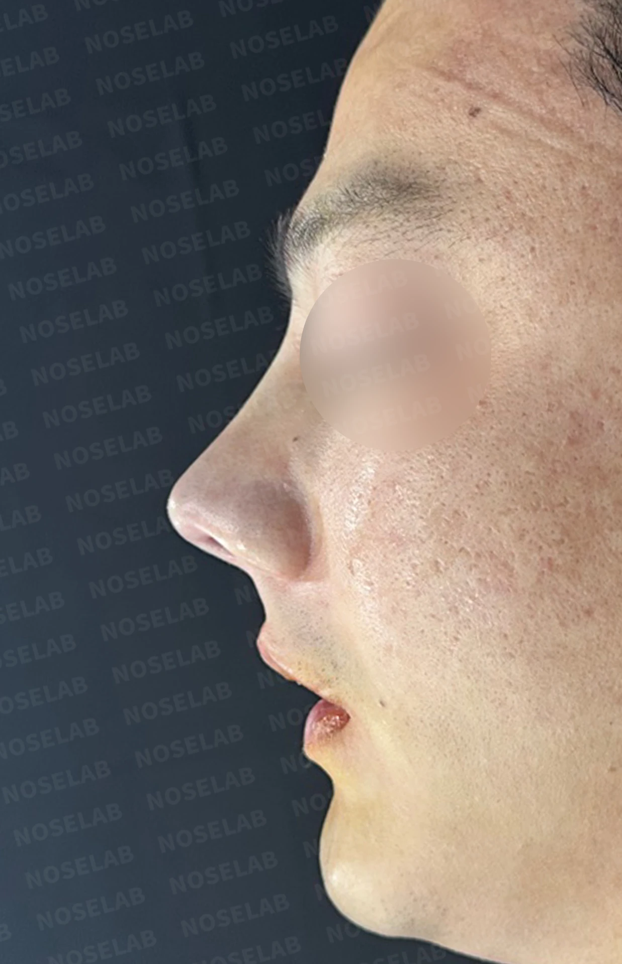 콧구멍 비대칭과 들린 코가 함께 생기는 이유, 늑연골 재건은 어떻게 하나 — 수술 전 / 수술 직후 0일 직후 사진은 부기가 있는 상태로 최종 결과와 다를 수 있습니다.