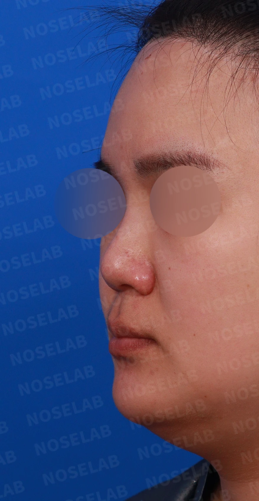 코에 삽입된 매선을 제거하고 재건하는 방법 — 디자인 상담 정면, 좌측 측면, 비스듬한 측면 사진입니다.