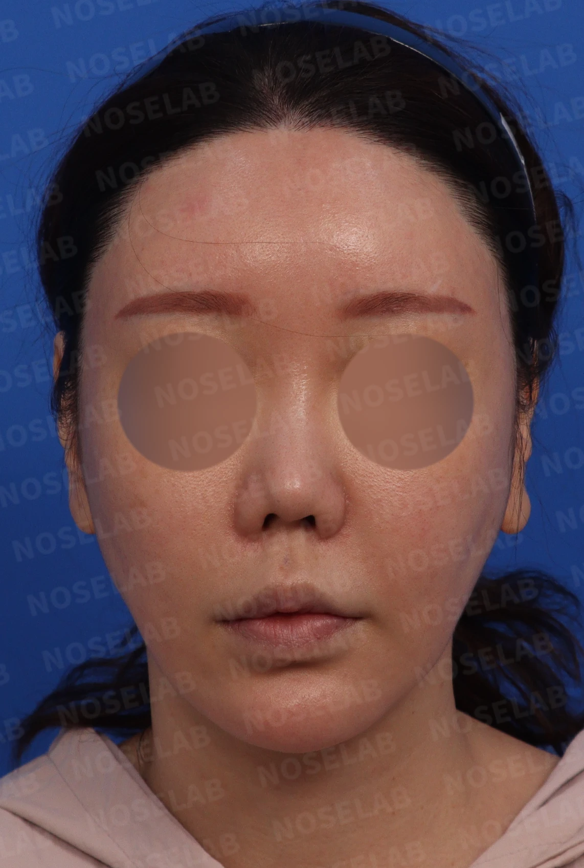 비주 함몰과 복코, 비공 비대칭의 교정 방법 — 정면, 측면, 비스듬한 측면