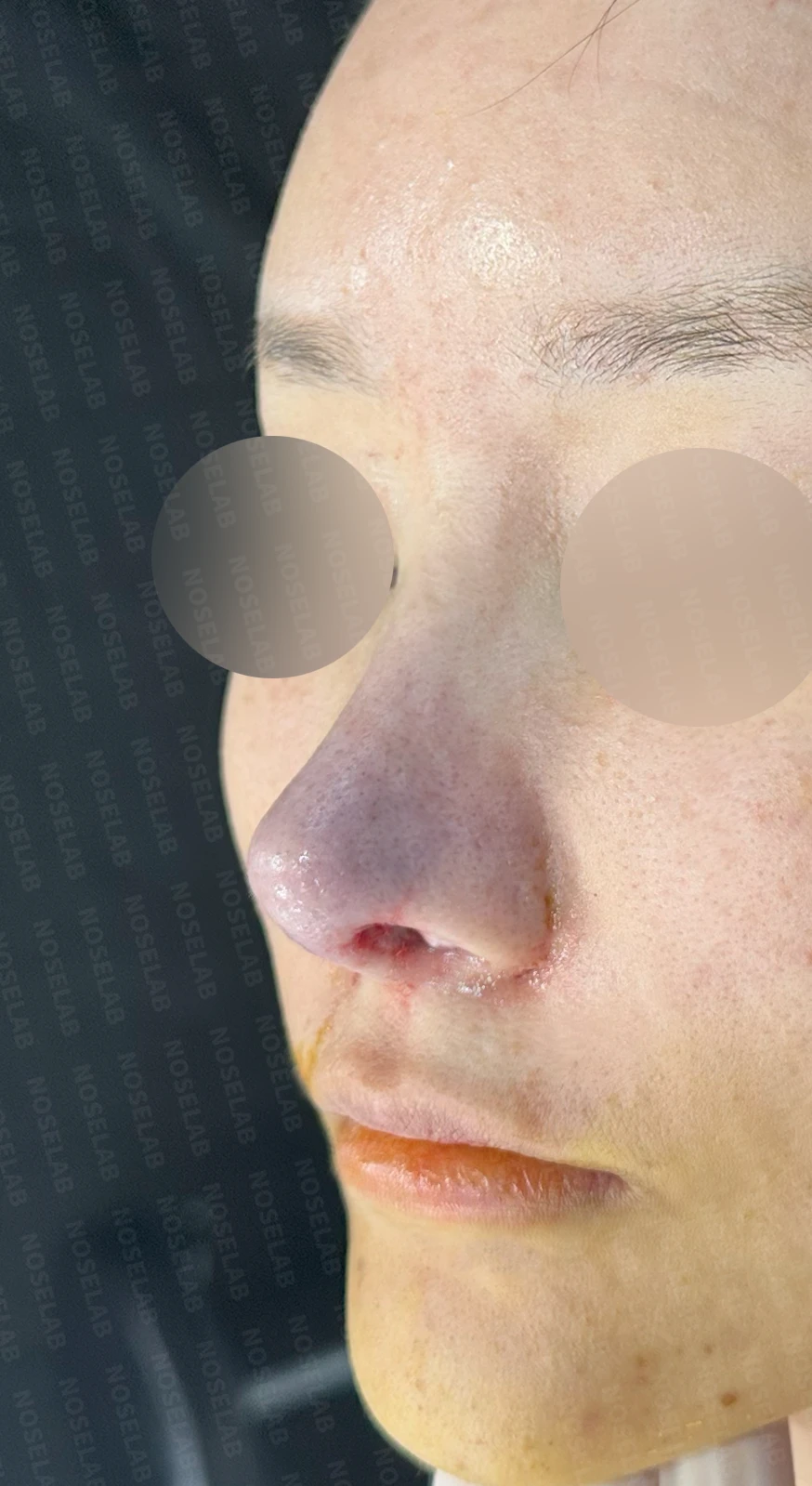 흡수된 기증늑연골을 자가늑연골로 교체 사례 — 전(좌) 직후(우)
