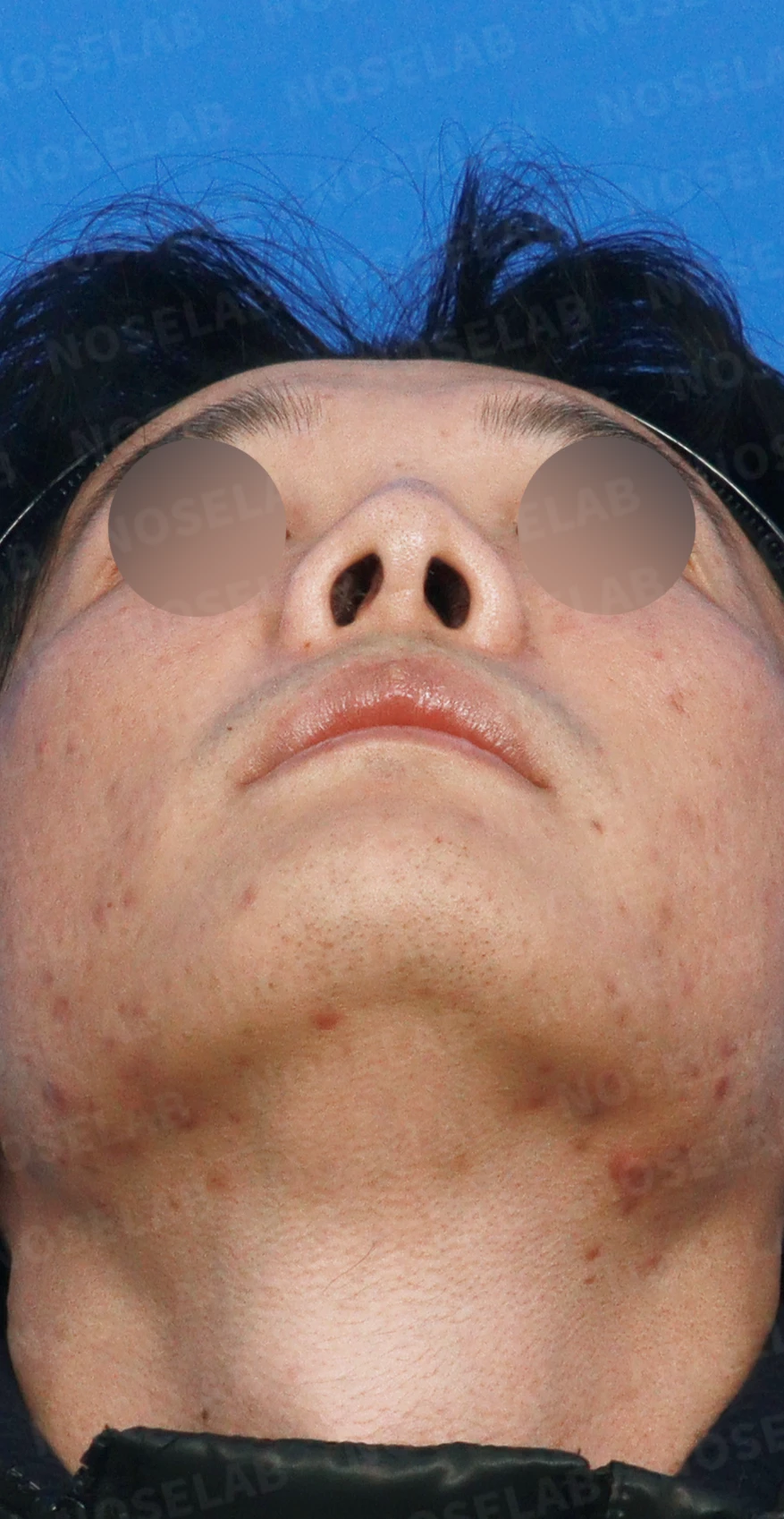 구축이 진행된 코, 조직 제거와 자가 늑연골 재건은 어떻게 하나 — 디자인 상담 우측 측면, 비스듬한 측면, 비공 사진입니다.