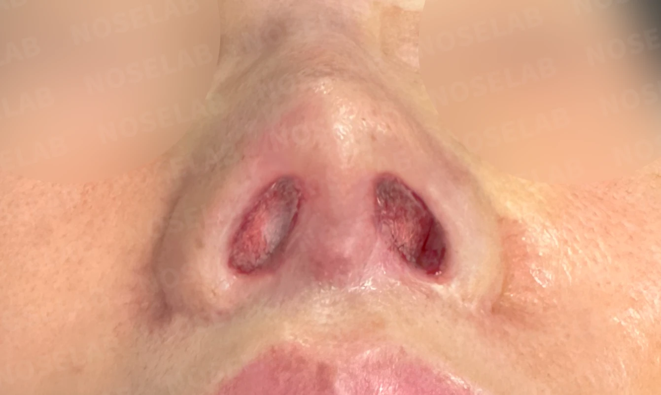 여러 차례 수술 뒤 비중격이 손상되면, 늑연골 재건은 어떻게 하나 — 수술 직후 0일 비공 사진입니다. 직후 사진은 부기가 있는 상태로 최종 결과와 다를 수 있습니다.