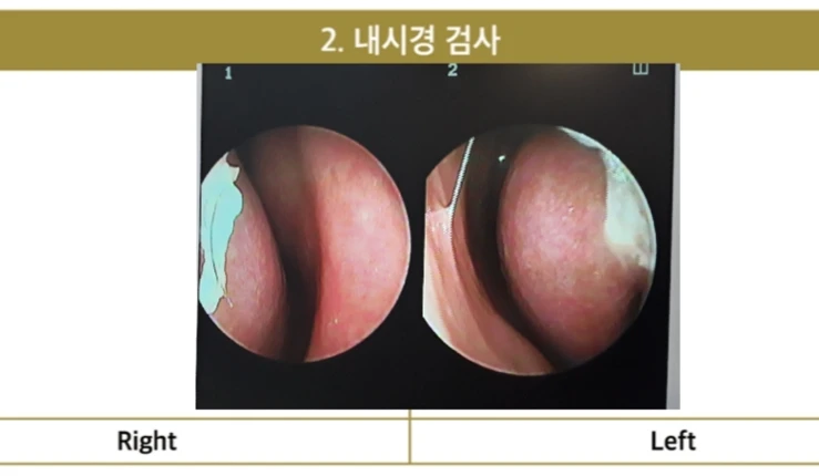 들린코, 작은코, 비순각 교정 사례 - 기능과 미용을 동시에 잡다 — 코 내시경 검사 사진입니다.