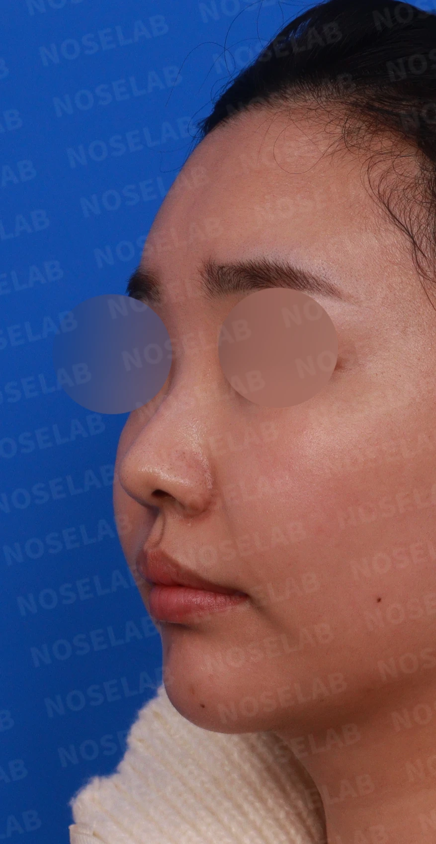 비염 수술을 받았는데도 코막힘이 돌아오는 이유, 구조 교정은 어떻게 하나 — 디자인 상담 정면, 좌측 측면, 비스듬한 측면 사진