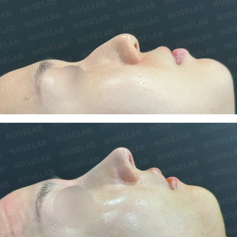 퍼진 코와 복코를 함께 교정하는 방법 — 전후 비교