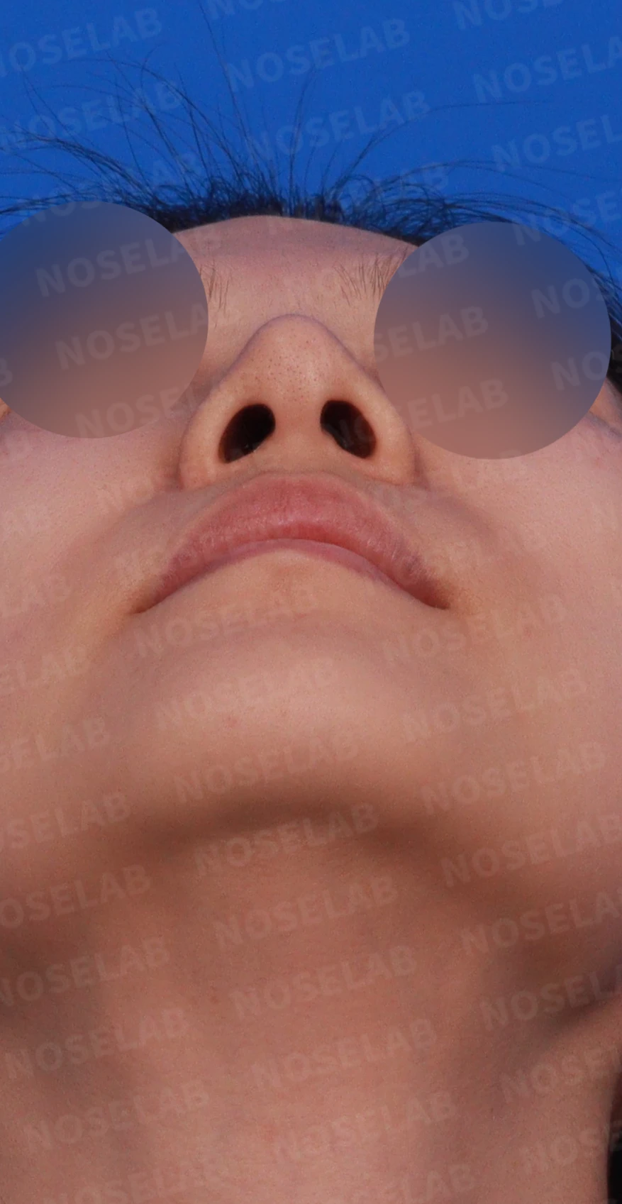 코끝과 콧대 비침 개선 - 자가늑연골, 진피이식 후기 — 디자인 상담 우측 비스듬한 측면, 측면, 비공 사진