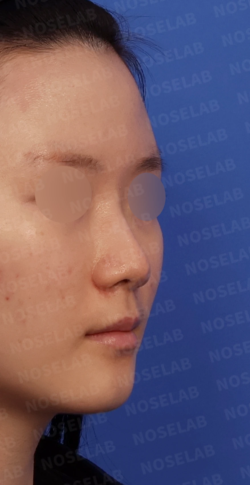 콧대가 퍼져 보이고 코끝이 뭉툭한 이유, 절골술과 자가 늑연골 교정은 어떻게 하나 — 디자인 상담 우측 측면, 비스듬한 측면, 비공 사진입니다.