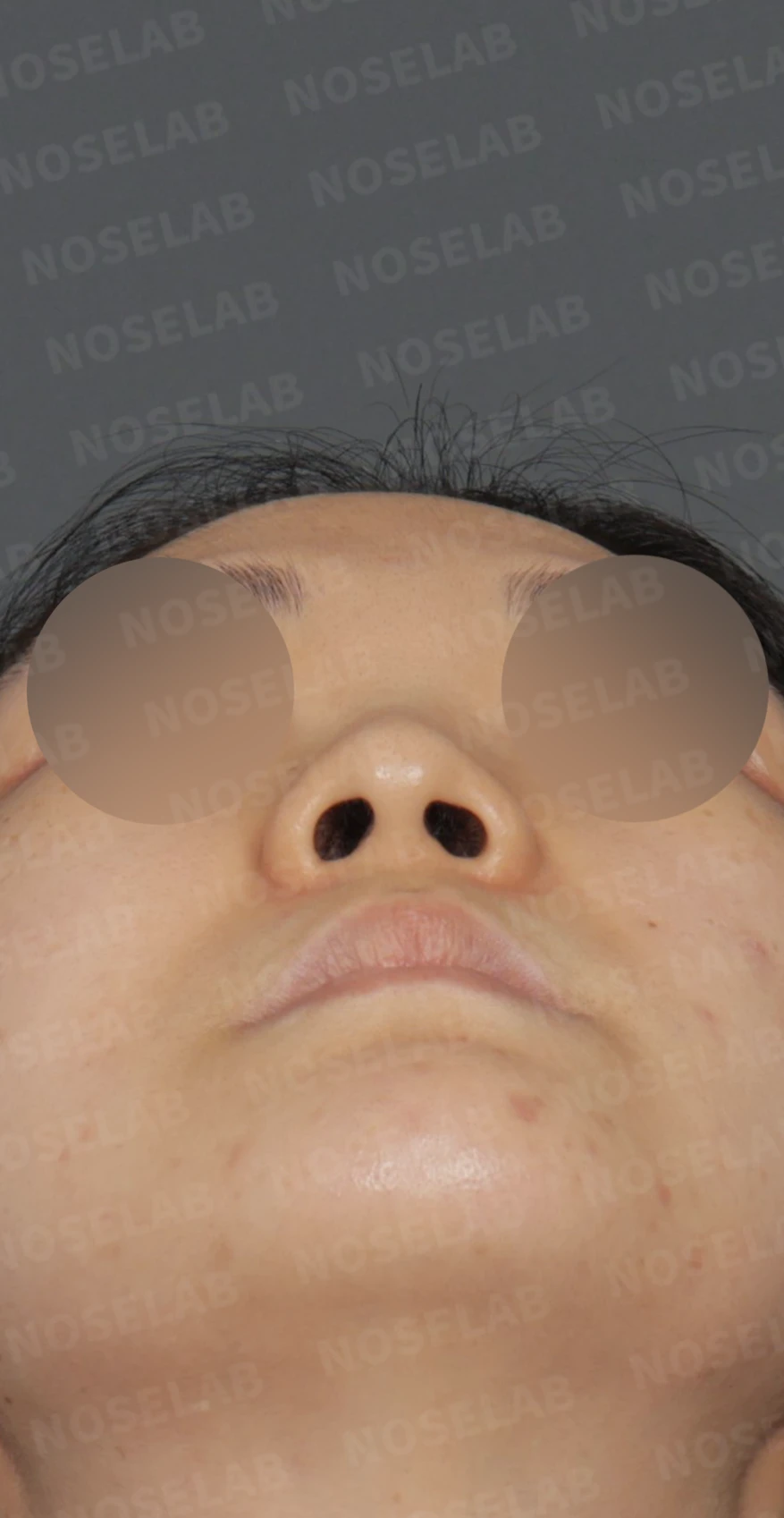 안면 비대칭과 휜코, 자가늑연골 비중격 재건으로 자연스럽게 교정한 코성형 — 디자인 상담 우측 측면, 비스듬한 측면, 비공 사진입니다.