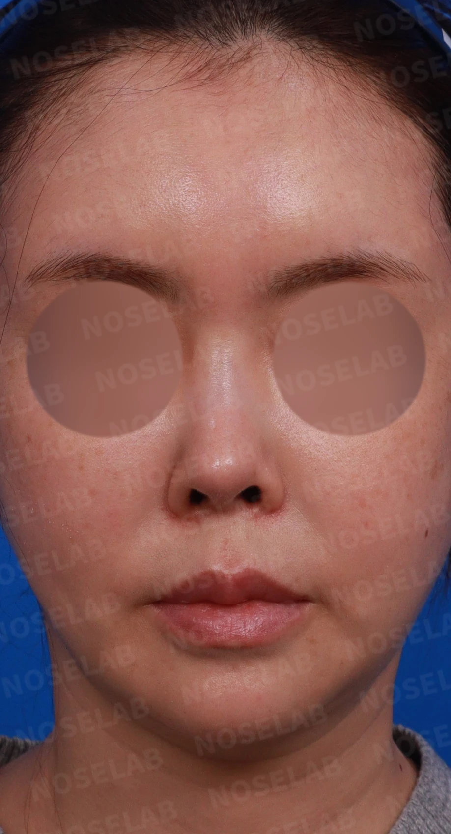 들린 코와 손상된 지지 구조의 재건 방법 — 디자인 상담 정면, 좌측 비스듬한 측면, 측면 사진입니다.